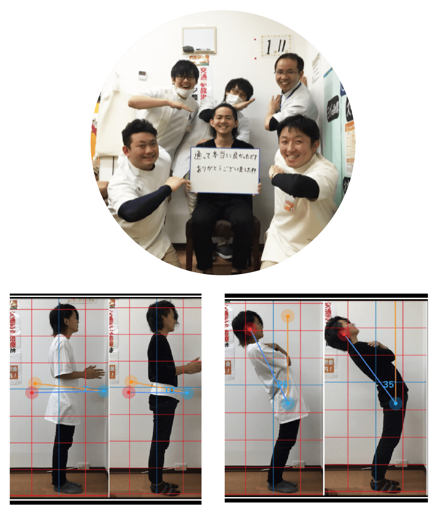ヘルニアが改善した患者様の写真と姿勢ビフォーアフター