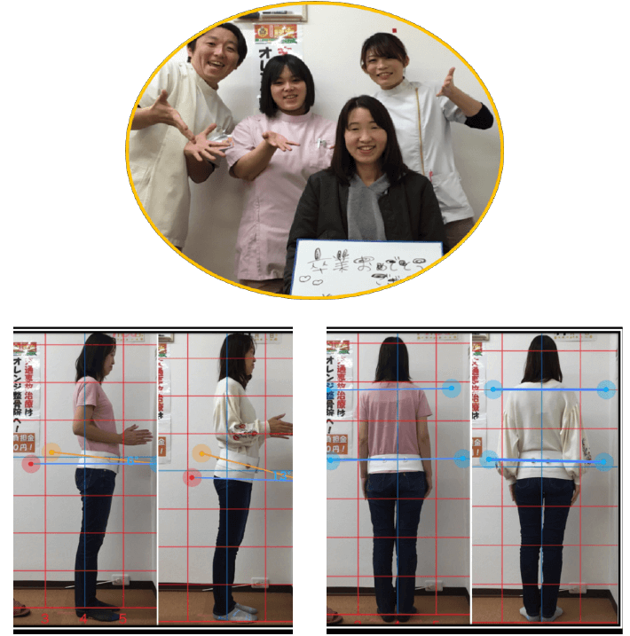 肩こりが改善した患者様の写真と姿勢ビフォーアフター