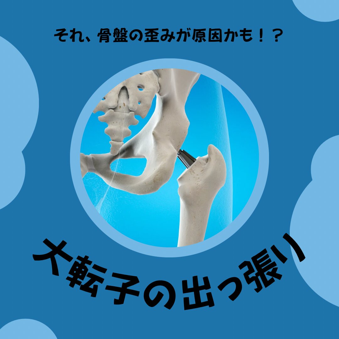 大転子の出っ張り.png